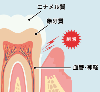 知覚過敏のイラスト