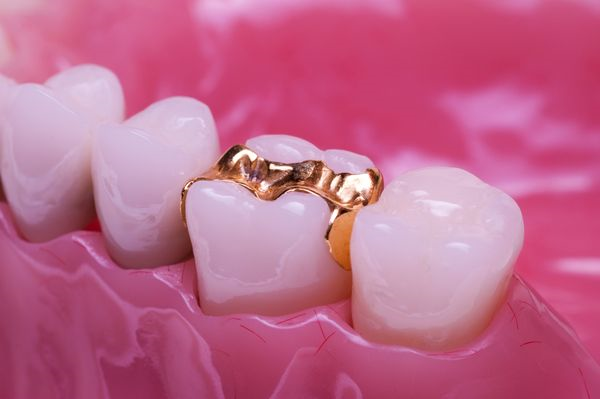 歯科で用いるインレーの写真
