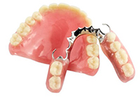 入れ歯の支台歯被覆型義歯