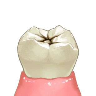 歯科 シーラント