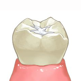 歯科 シーラント