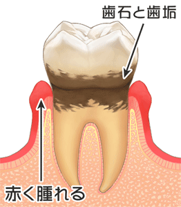 歯科 歯周病の進行