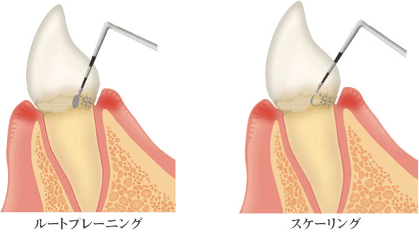 歯科 歯周病治療